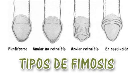 fimosis foto|Los 5 Tipos de Fimosis